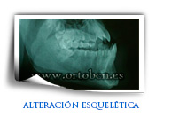 clase III esquelética